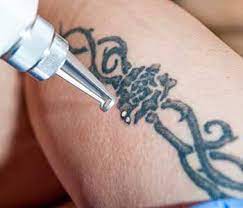 A note from cleveland clinic. Laser Tattoo Removal Cleveland Oh Fotona Qx Max Pico Technology