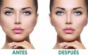 Un lado más hinchado después de la bichectomia. Todo Lo Que Quieres Saber Sobre La Bichectomia Dental Innovation Formacion Cursos Odontologos Dentistas
