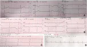 A diagnosis may be supported by an electrocardiogram (ecg), increased troponin, heart mri, and occasionally a heart biopsy. Electrocardiogramas De Pacientes Con Miocarditis Por Dengue A Ritmo Download Scientific Diagram