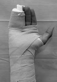 Image result for Ulnar Gutter Splint