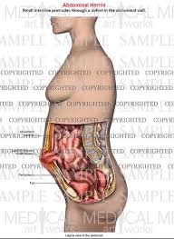 Abdominal anatomy pictures female : Abdominal Hernia Anatomy Of Female Lateral Single View Medical Art Works