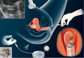 Suhu dasar dan cara menghitung ovulasi di rumah sendiri. Embryo Implantasi 25 Gambar Tanda Tanda Implantasi Dalam Uterus Ovum Gejala Penyisipan Lewat Dan Awal Suhu Basal Dan Sensasi