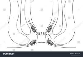 Ass Anal: Over 183 Royalty-Free Licensable Stock Illustrations & Drawings |  Shutterstock