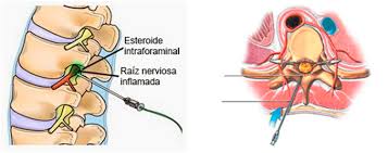 Aunque es una forma de artrosis, la espondilosis cervical. Tratamiento Del Dolor Cronico Cervical Y Lumbar Neurocirugia Katati
