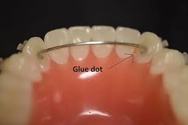 Ortho Care From Home Sayre Orthodontics Bozeman Mt