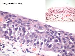 The Changing Incidence Of Carcinoma In Situ Of The Bladder Worldwide Intechopen