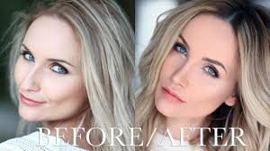 Exista doua tipuri de rinoplastie: Totul Despre Operatia Mea De Rinoplastie Before After Youtube