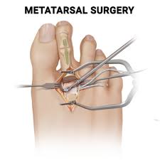 Image result for Metatarsal