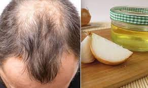 Onion is useful against hair loss because of its high sulfur content. Hair Loss Treatment Alopecia Prevented By Adding Onion Juice To Your Diet Express Co Uk