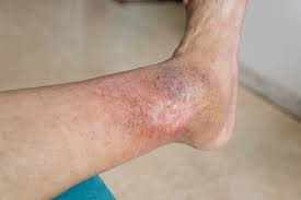 Image result for Skin Ulcer