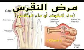 مرض النقرس وكيفية التغلب عليه posts facebook