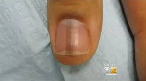 The tiny vessels in the nail bed are. Here S Why You Should See A Doctor If You Notice Black On Your Nail