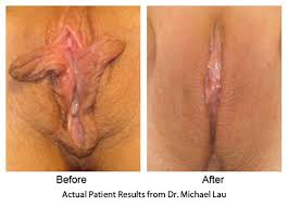 Northam, a member of the democratic party, served as the 40th lieutenant governor of virginia from 2014 to 2018 prior to winning the. Lip Jobs Before And After Mega Porn Pics