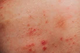 The rash of erythema multiforme appears as symmetrical plaques on hands, forearms, feet and lower legs. Pin On Cheveux