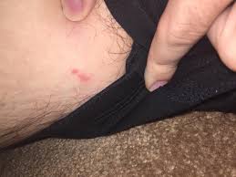 The man could also feel itchy in the areas around the buttocks and the thighs. Concerned About Rash On Thigh Image Included Herpes