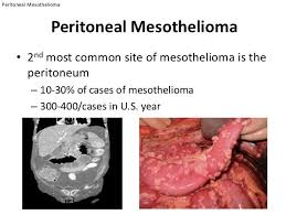 Find out about surgery for mesothelioma in the tummy (abdomen). Mesothelioma Law Firm Peritoneal Mesothelioma Symptoms Life Expectancy Peritoneal Cancer Survival Rate Prognosis Treatment Chemotherapy Radiation Therapy