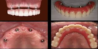 Dental Implants Are Necessary In Cases Of Extreme Wear And Tear Of The Teeth But Before You Visit A Dent Denture Implants Dental Implants Cost Dental Implants