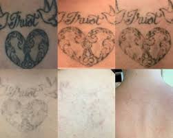 Tattoo removal charleston usa ivy laser salon lowcountry male microblading, tattoo removal, beauty salon, eyebrows, eyelashes extensions, hair restoration, laser hair removal. My Tattoo Removal Experience Beauty And The Blonde