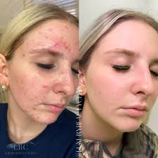 Summer skin is made in the winter! ❄️✨ Celebrating this snow week with this  incredible skin transformation ! Treatment plan details: 1. CONSISTENCY 2.  Custom @janmariniskinresearch 4 product AT HOME regimen With
