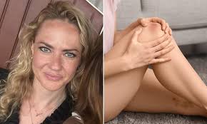 Back in her pink boots, girl, two, who lost both legs to meningitis but is  now taking her first steps