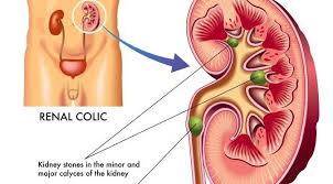 Remove Kidney Stones With This Amazing Herb With Images Kidney Stones Kidney Biopsy Chronic Kidney Disease