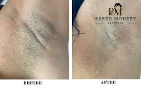 4) elelsilk laser hair removal device. Bared Monkey Laser Spa Penn Station 125 Photos 339 Reviews Laser Hair Removal 38 W 32nd St New York Ny Phone Number