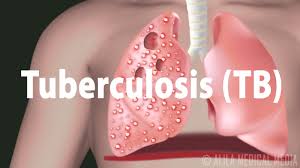 An estimated 60 million lives were saved through tb diagnosis and treatment between 2000 and 2019. Tuberculosis Tb Progression Of The Disease Latent And Active Infections Youtube