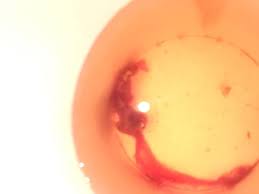 Miscarriage is one of those things that sits in the back of a woman's mind during pregnancy, and it's a fair concern given that the rate of miscarriage can run anywhere from 10% to 20% among women who know they are pregnant. Miscarriage Please Anyone Help Tmi Pictures Glow Community