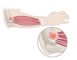 While these conditions are commonly known as golfer's elbow and tennis elbow, they are not limited to athletes! Lateral And Medial Epicondylitis Summit Orthopedics