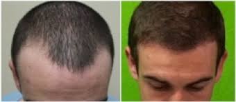 Image result for Hair Growth Rate