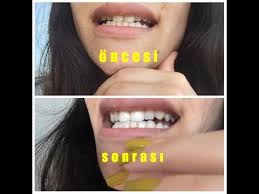 Dis Tonunu 2 3 Ton Acan Kur Dis Beyazlatma Youtube Dis Youtube Karbonat