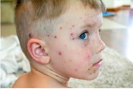 Image result for ekzema face