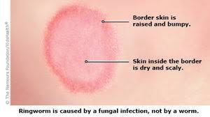 Image result for ringworm