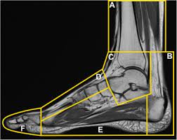 Muscle mri sequences & patterns asymmetric myopathy hereditary acquired connective tissue neurogenic. Mri Of Complex Regional Pain Syndrome In The Foot European Journal Of Radiology