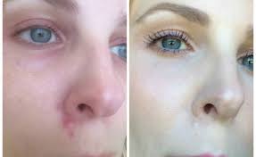 Honestly you can transform your face, without an inch of make up being detectable on the skin, ward explains on instagram, adding. How To Cover Up A Flaky Pimple Beautynow Blog