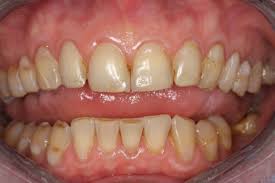 Abgenutzte Zahne Interview Mit Prof Dr Olze Zahnarzt Berlin Mitte