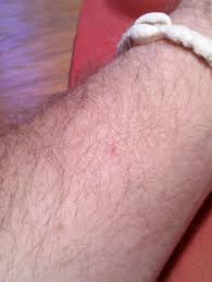 We&#x27;ll show you some pictures of the most common types but even they can vary in appearance, depending in part on things like the size of the cancerous lesion, where on the body cancer develops, your skin tone, and how advanced the cancer is. Listen Uncle Crappy