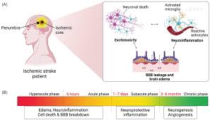 Image result for Stroke Pathophysiology