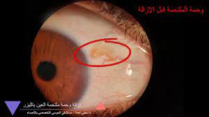 ٧ عوامل الإصابة بالماء الأبيض في العين. Ø¹Ù„Ø§Ø¬ ÙˆØ­Ù…Ø© Ù…Ù„ØªØ­Ù…Ø© Ø§Ù„Ø¹ÙŠÙ† Ø¨Ø§Ù„Ù„ÙŠØ²Ø± Youtube
