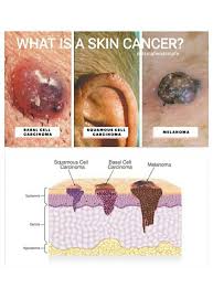 A cancerous growth that forms on or inside the body 2. Mdsmafe What Is A Skin Cancer Skin Cancer The Facebook