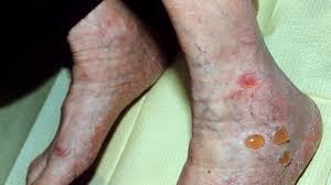 The best thing that a person who has diabetes can do is prevent diabetic dermopathy from occurring by controlling your. 10 Diabetic Skin Problems Everyday Health