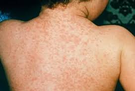 Image result for measles