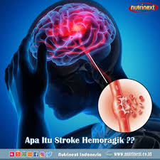 Apa Itu Stroke Hemoragik Apa Movie Posters Strokes