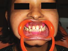 Oral rehabilitation of a young patient with hypohidrotic ectodermal  dysplasia: A clinical report
