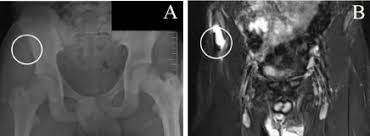 Your doctor might recommend that you use crutches to keep weight off the hip while it heals. Surgical Treatment Of A Young Athlete With Displaced Avulsion Fracture Of The Anterior Superior Iliac Spine Asis