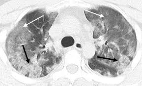 CT Imaging Features of 2019 Novel Coronavirus (2019-nCoV)Radiology