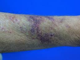 This type of bruising typically involves small bleeding that occurs under the skin. Senile Purpura Dermnet Nz