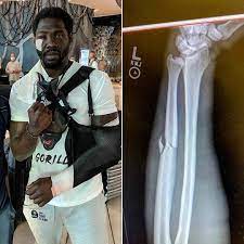 Jared cannonier celebrates his tko victory over jack hermansson at royal arena on sept. Mma India On Twitter Here S An X Ray Of Jared Cannonier S Arm That He Fractured In The Beginning Of The First Round Of His Fight Against Whittaker It Was The Very First Kick