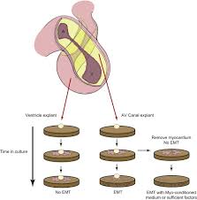 Image result for Endocardial Cushion Defect