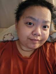 Is it true gallbladder removal can cause a lot of health issues